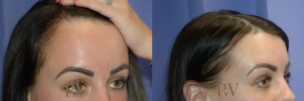 Paul Wilson - Hairline Lowering (Foreheadplasty) Patient Image 12