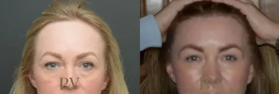 Paul Wilson - Hairline Lowering (Foreheadplasty) Patient Image 13