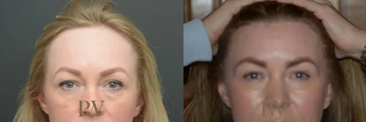 Paul Wilson - Hairline Lowering (Foreheadplasty) Patient Image 13
