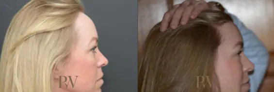 Paul Wilson - Hairline Lowering (Foreheadplasty) Patient Image 14