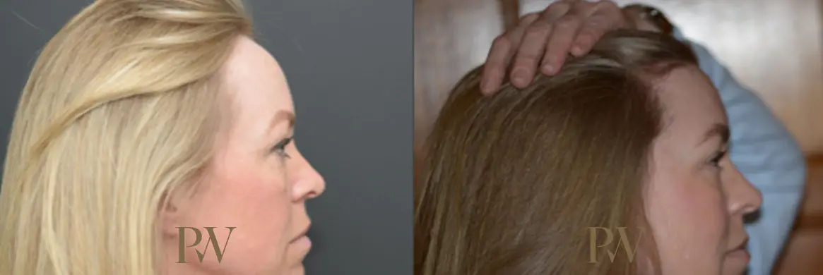 Paul Wilson - Hairline Lowering (Foreheadplasty) Patient Image 14