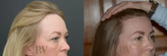 Paul Wilson - Hairline Lowering (Foreheadplasty) Patient Image 15