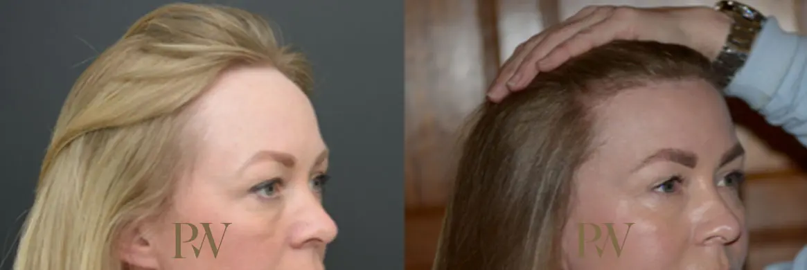 Paul Wilson - Hairline Lowering (Foreheadplasty) Patient Image 15