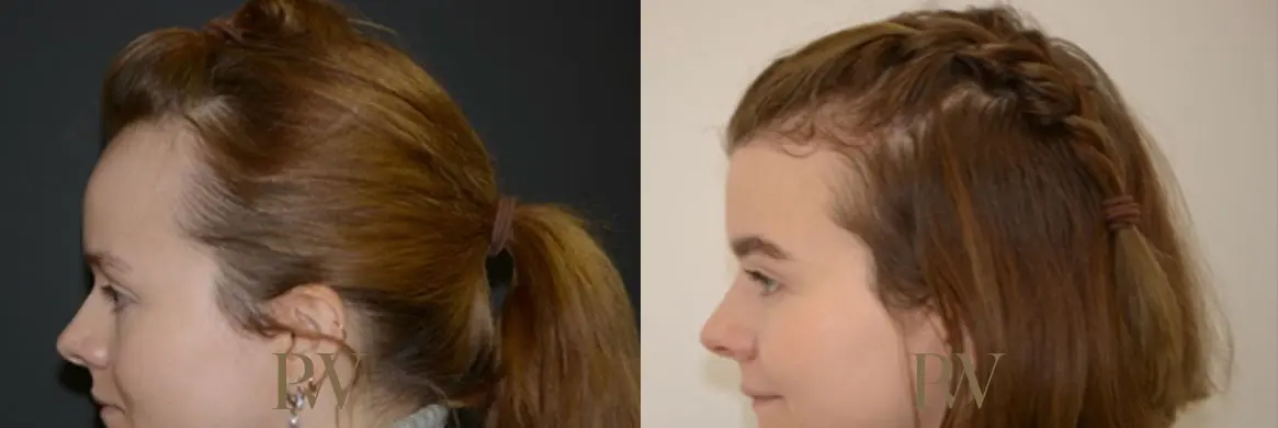 Paul Wilson - Hairline Lowering (Foreheadplasty) Patient Image 16