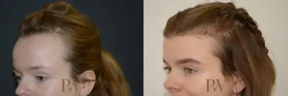 Paul Wilson - Hairline Lowering (Foreheadplasty) Patient Image 17
