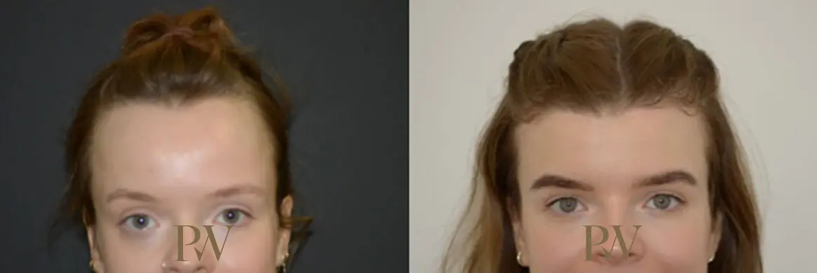 Paul Wilson - Hairline Lowering (Foreheadplasty) Patient Image 18