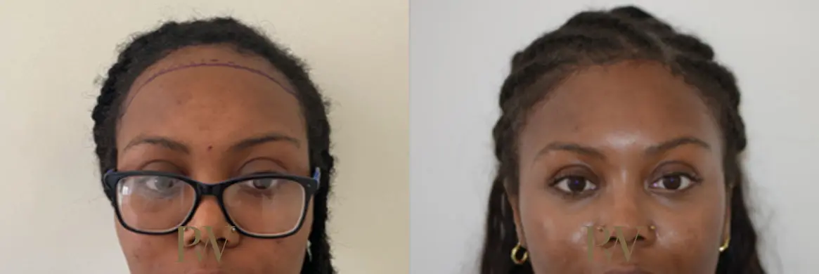 Paul Wilson - Hairline Lowering (Foreheadplasty) Patient Image 19