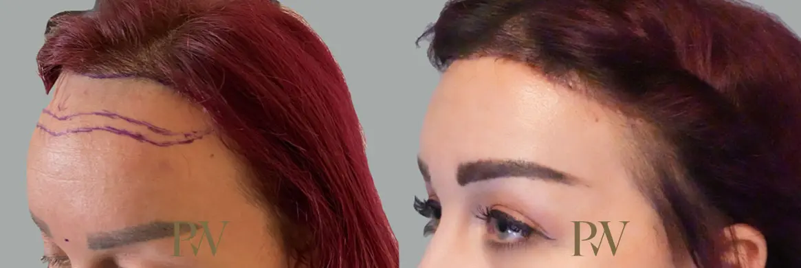 Paul Wilson - Hairline Lowering (Foreheadplasty) Patient Image 2