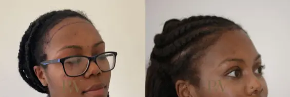 Paul Wilson - Hairline Lowering (Foreheadplasty) Patient Image 20