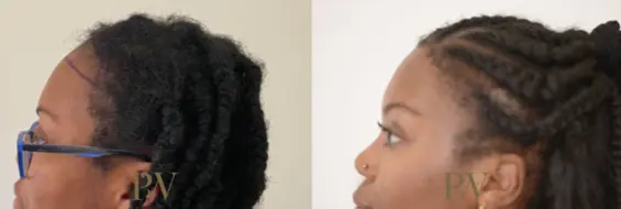 Paul Wilson - Hairline Lowering (Foreheadplasty) Patient Image 21