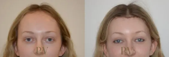 Paul Wilson - Hairline Lowering (Foreheadplasty) Patient Image 22