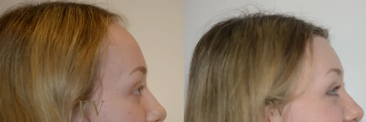 Paul Wilson - Hairline Lowering (Foreheadplasty) Patient Image 23