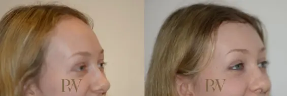 Paul Wilson - Hairline Lowering (Foreheadplasty) Patient Image 24