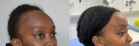 Paul Wilson - Hairline Lowering (Foreheadplasty) Patient Image 25