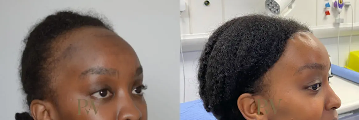 Paul Wilson - Hairline Lowering (Foreheadplasty) Patient Image 25