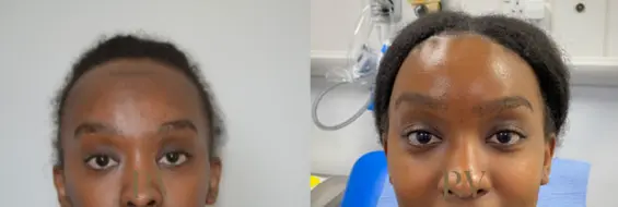 Paul Wilson - Hairline Lowering (Foreheadplasty) Patient Image 26