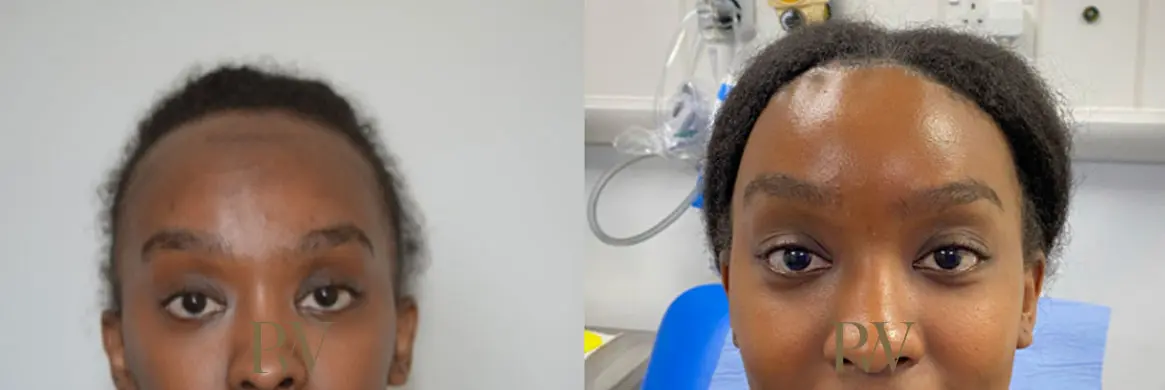 Paul Wilson - Hairline Lowering (Foreheadplasty) Patient Image 26