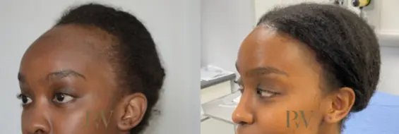 Paul Wilson - Hairline Lowering (Foreheadplasty) Patient Image 27