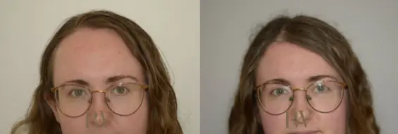 Paul Wilson - Hairline Lowering (Foreheadplasty) Patient Image 28