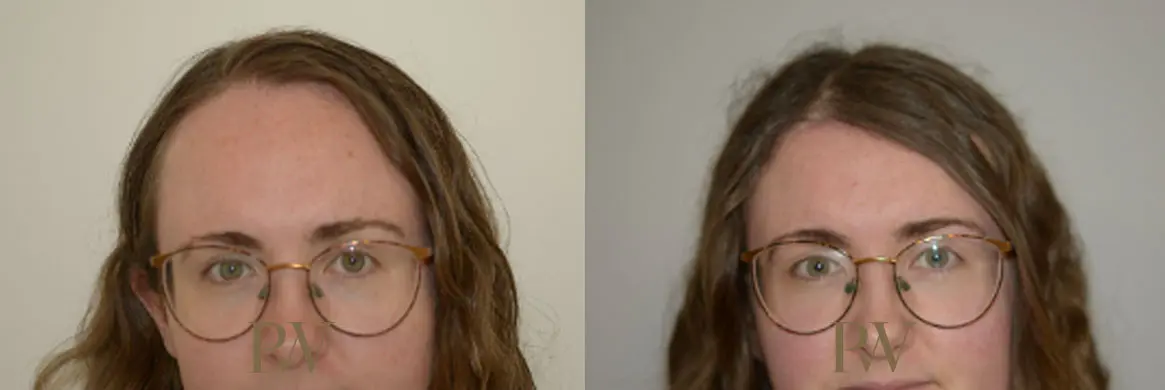 Paul Wilson - Hairline Lowering (Foreheadplasty) Patient Image 28