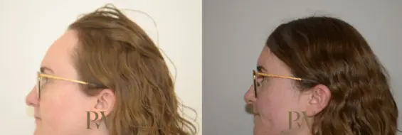 Paul Wilson - Hairline Lowering (Foreheadplasty) Patient Image 29