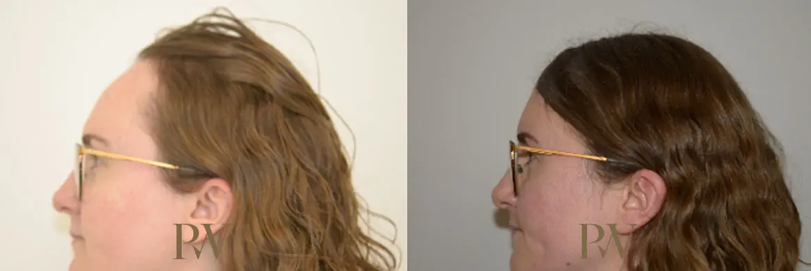 Paul Wilson - Hairline Lowering (Foreheadplasty) Patient Image 29