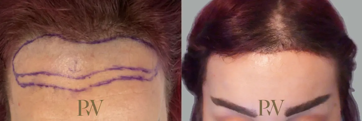Paul Wilson - Hairline Lowering (Foreheadplasty) Patient Image 3