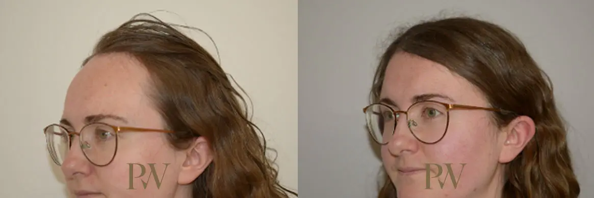 Paul Wilson - Hairline Lowering (Foreheadplasty) Patient Image 30