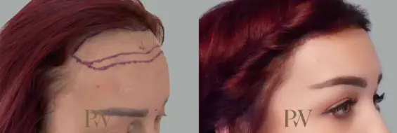 Paul Wilson - Hairline Lowering (Foreheadplasty) Patient Image 4