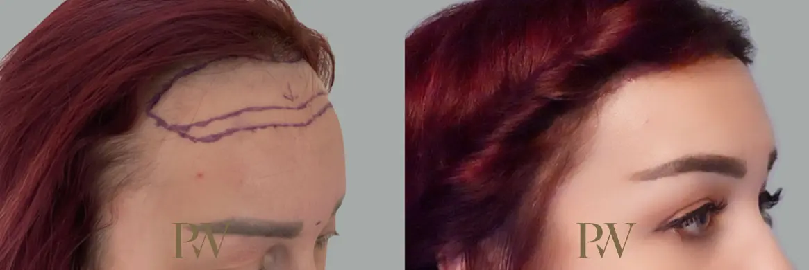 Paul Wilson - Hairline Lowering (Foreheadplasty) Patient Image 4