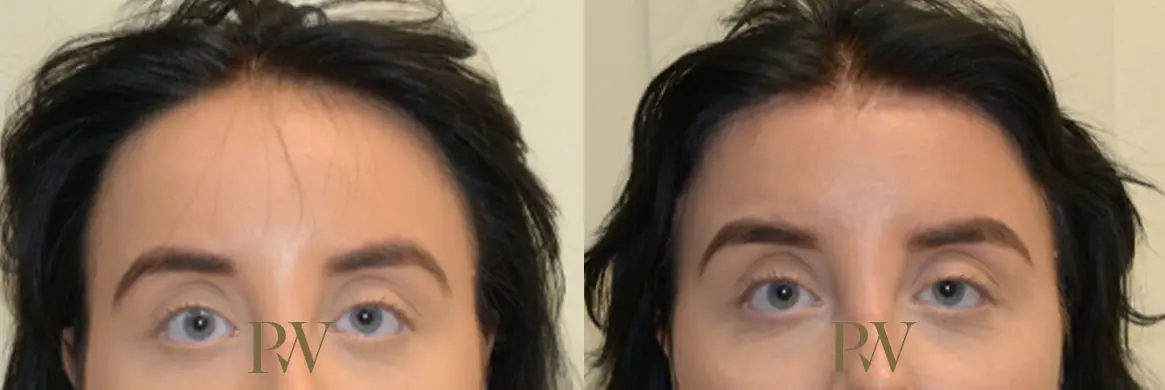 Paul Wilson - Hairline Lowering (Foreheadplasty) Patient Image 5