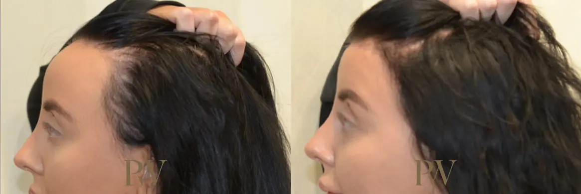 Paul Wilson - Hairline Lowering (Foreheadplasty) Patient Image 6