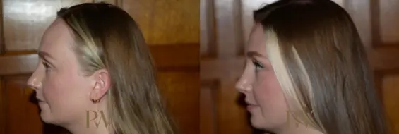 Paul Wilson - Hairline Lowering (Foreheadplasty) Patient Image 7