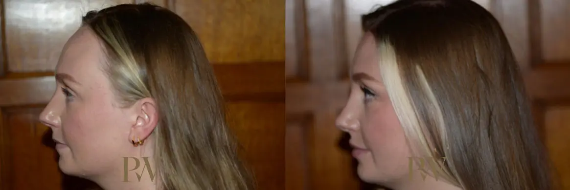 Paul Wilson - Hairline Lowering (Foreheadplasty) Patient Image 7