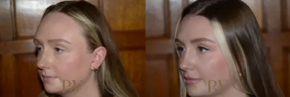 Paul Wilson - Hairline Lowering (Foreheadplasty) Patient Image 8