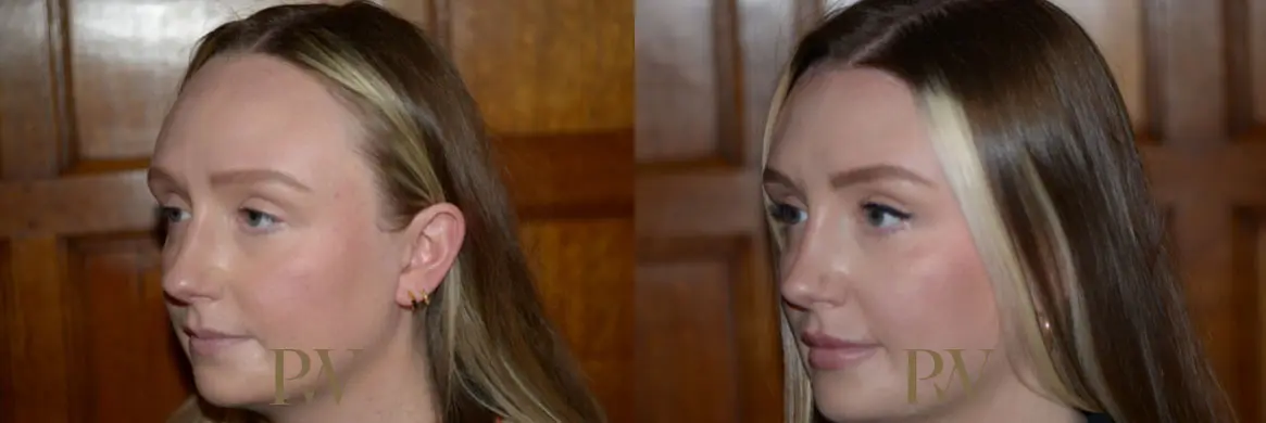 Paul Wilson - Hairline Lowering (Foreheadplasty) Patient Image 8