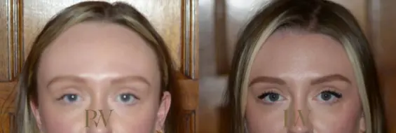 Paul Wilson - Hairline Lowering (Foreheadplasty) Patient Image 9