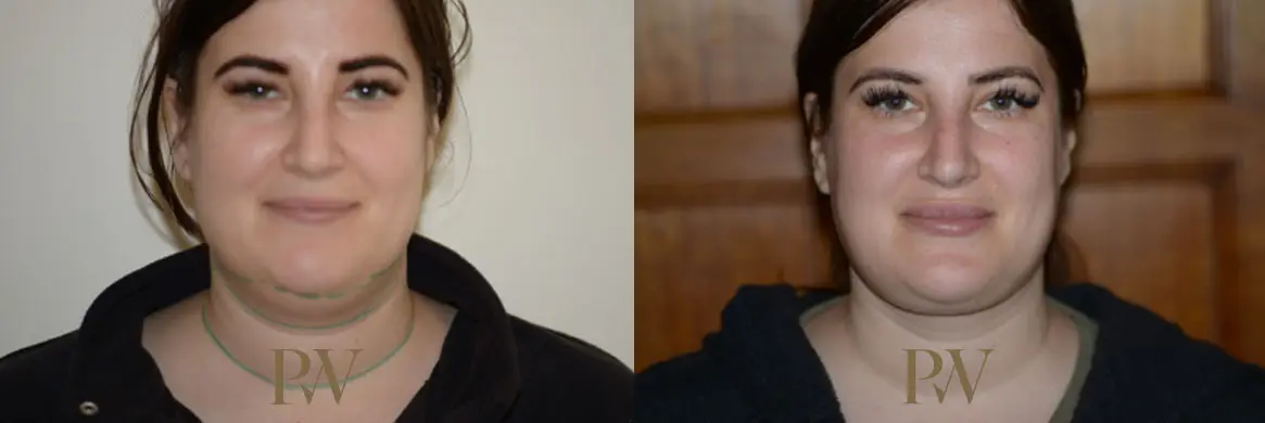 Paul Wilson - Liposuction Patient Image 1