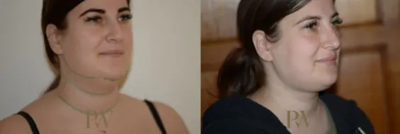 Paul Wilson - Liposuction Patient Image 2