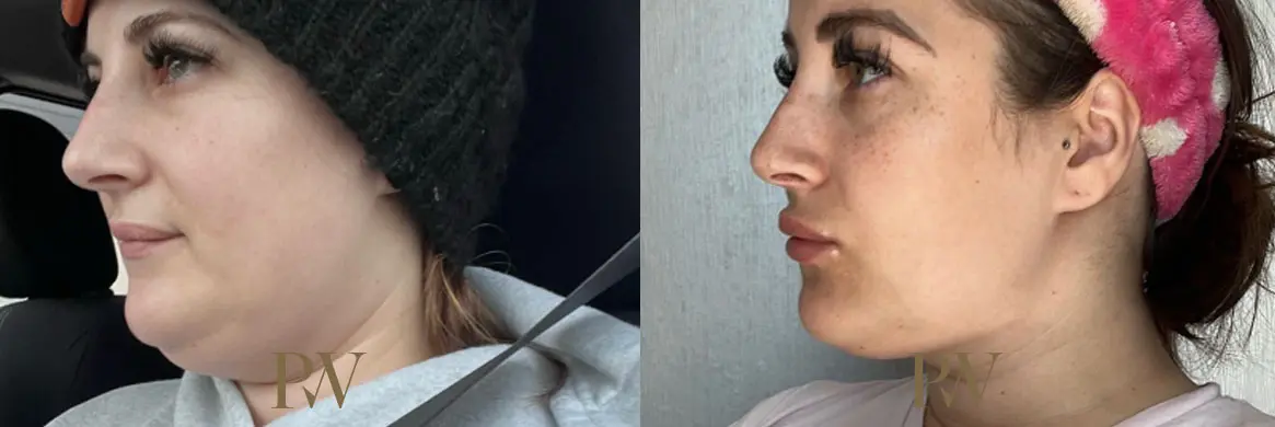 Paul Wilson - Liposuction Patient Image 3