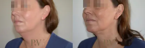 Paul Wilson - Liposuction Patient Image 4