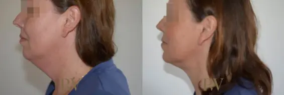 Paul Wilson - Liposuction Patient Image 5