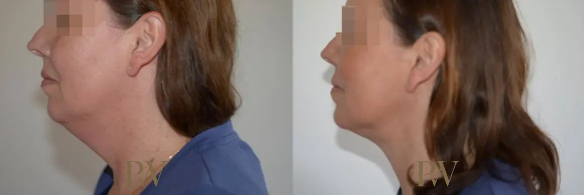 Paul Wilson - Liposuction Patient Image 5