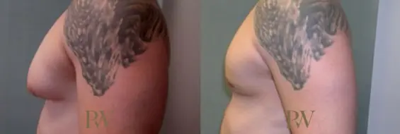 Paul Wilson - Male Breast Reduction Patient Image 1