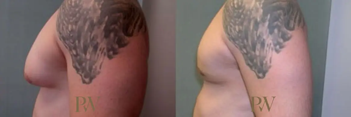 Paul Wilson - Male Breast Reduction Patient Image 1