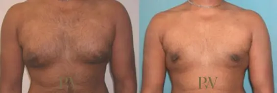 Paul Wilson - Male Breast Reduction Patient Image 10