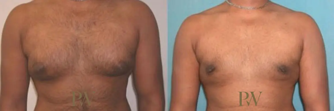 Paul Wilson - Male Breast Reduction Patient Image 10