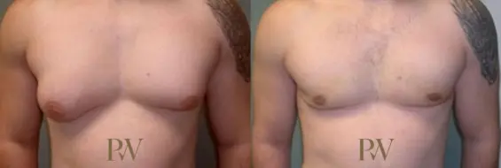 Paul Wilson - Male Breast Reduction Patient Image 2
