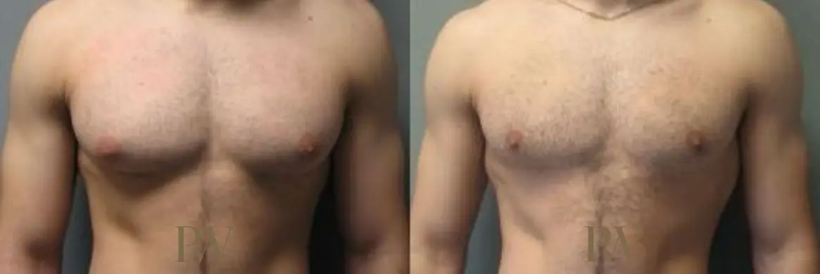 Paul Wilson - Male Breast Reduction Patient Image 3