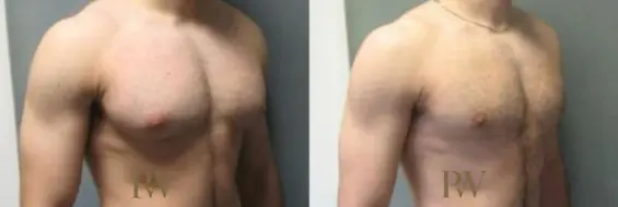 Paul Wilson - Male Breast Reduction Patient Image 4